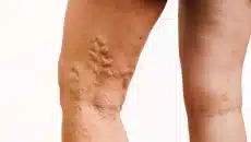 Varicose Vein