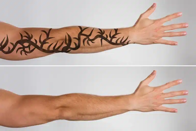 How Long Does Tattoo Removal Really Take?